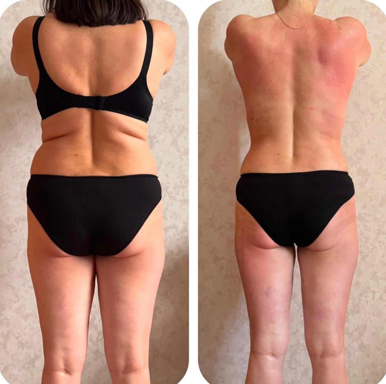 Коррекция фигуры: спина до и после