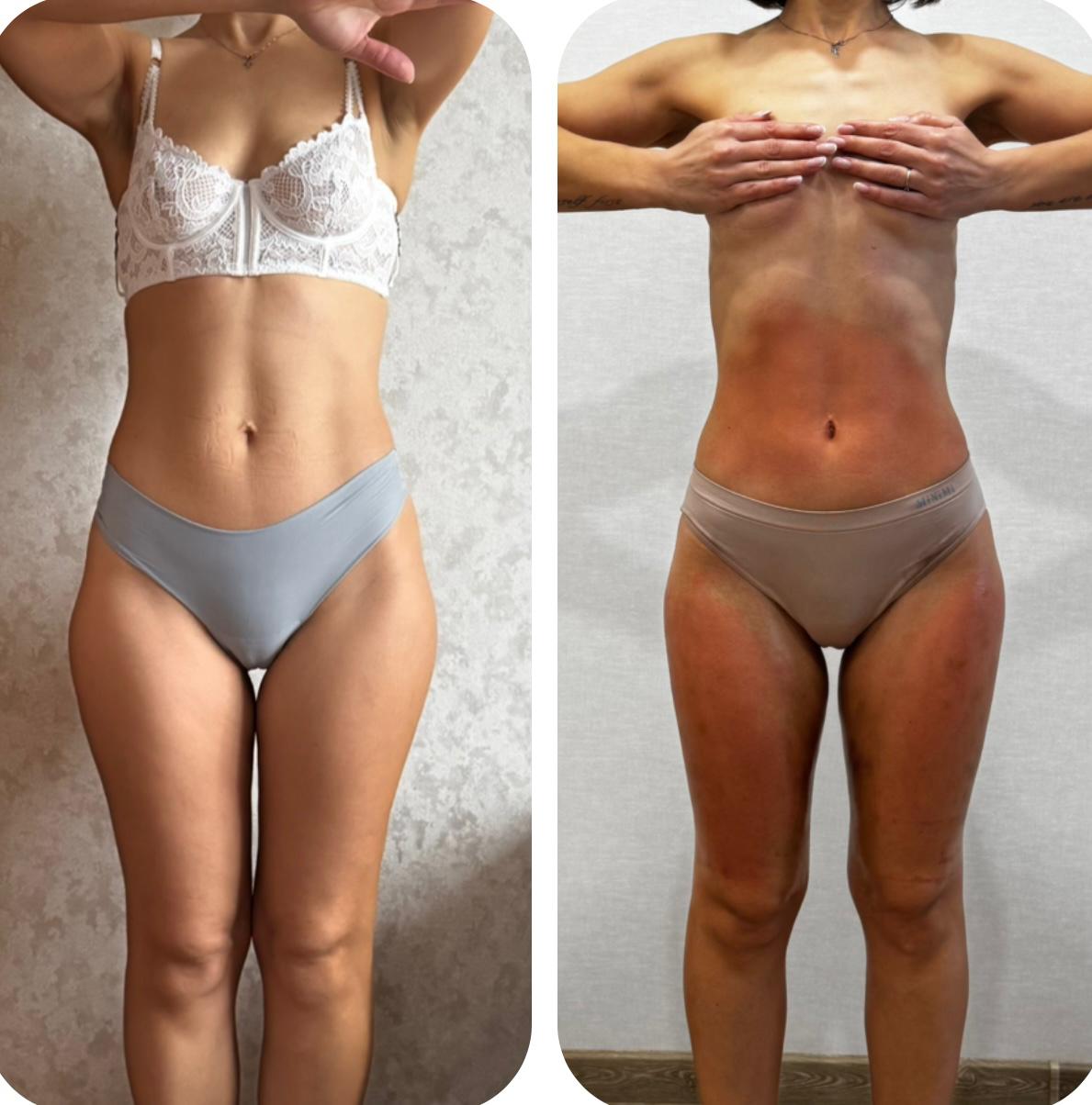 Подтяжка тела: до и после