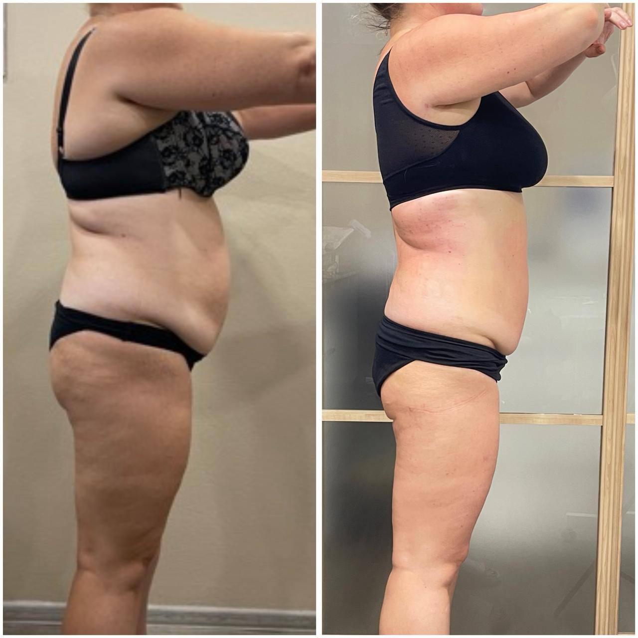 Коррекция фигуры: бок до и после