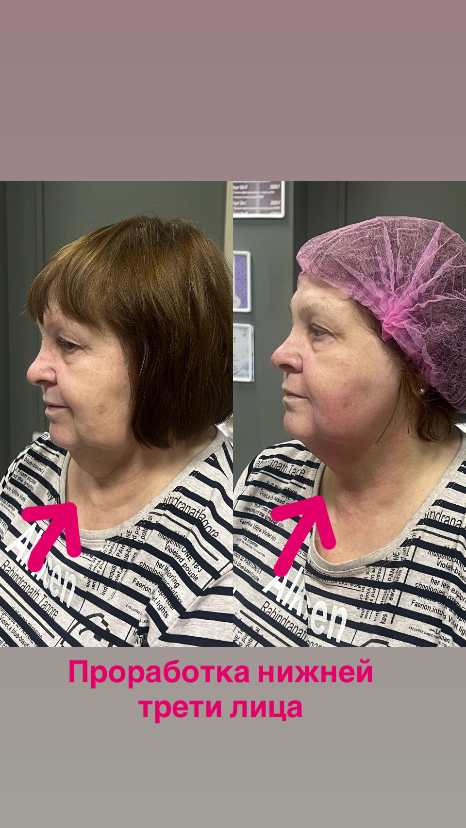 Лифтинг нижней трети лица