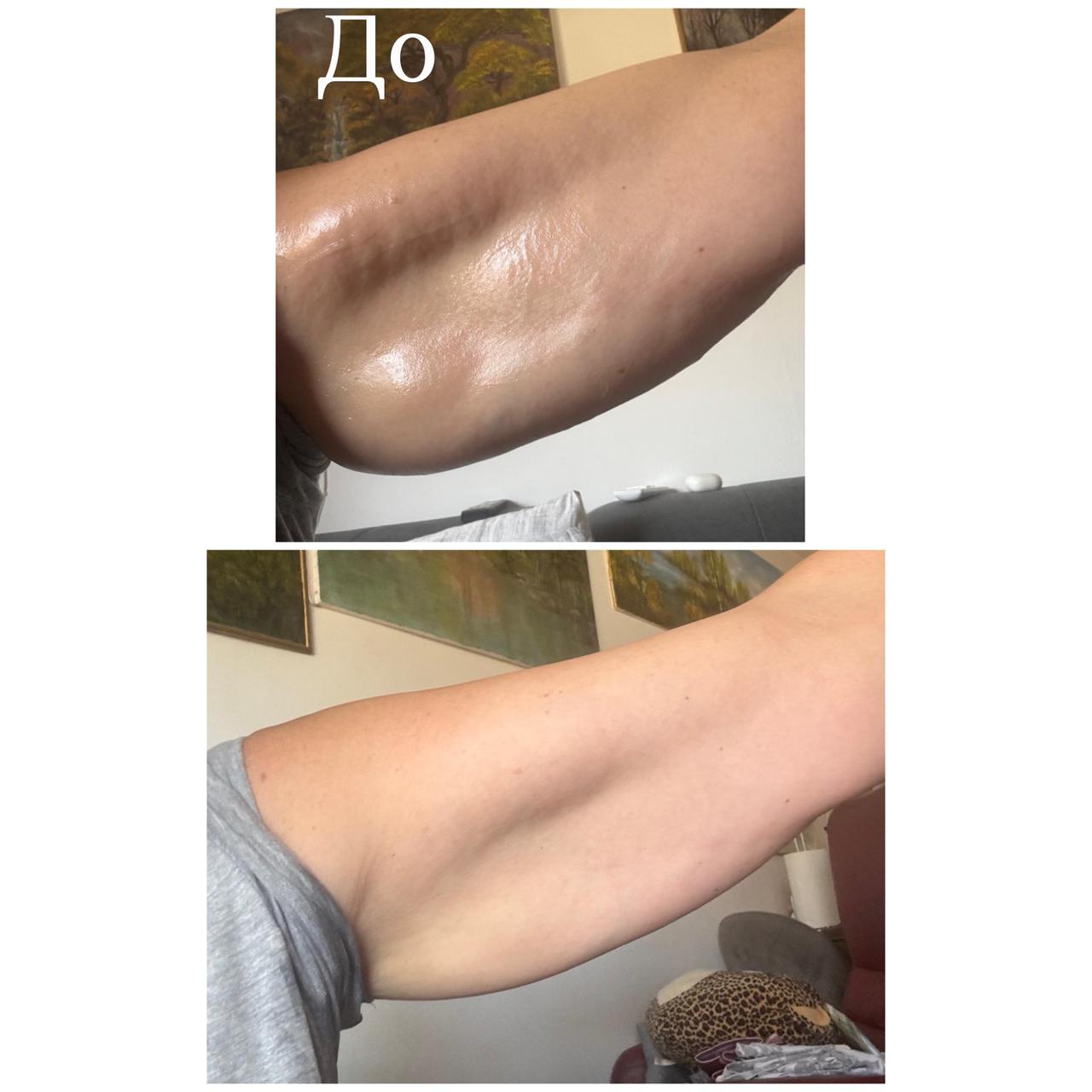 Лазерная эпиляция: до и после